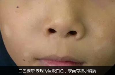 不是白癜风的白斑能查出是什么吗,不是白癜风的白点是啥