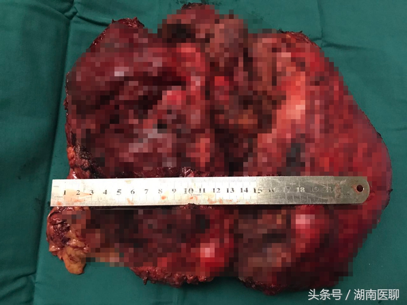 湖南女子腰间长“足球”大肿瘤进超市被怀疑偷东西