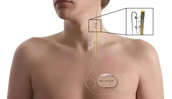 辅助迷走神经刺激术(VNS)治疗难治性抑郁