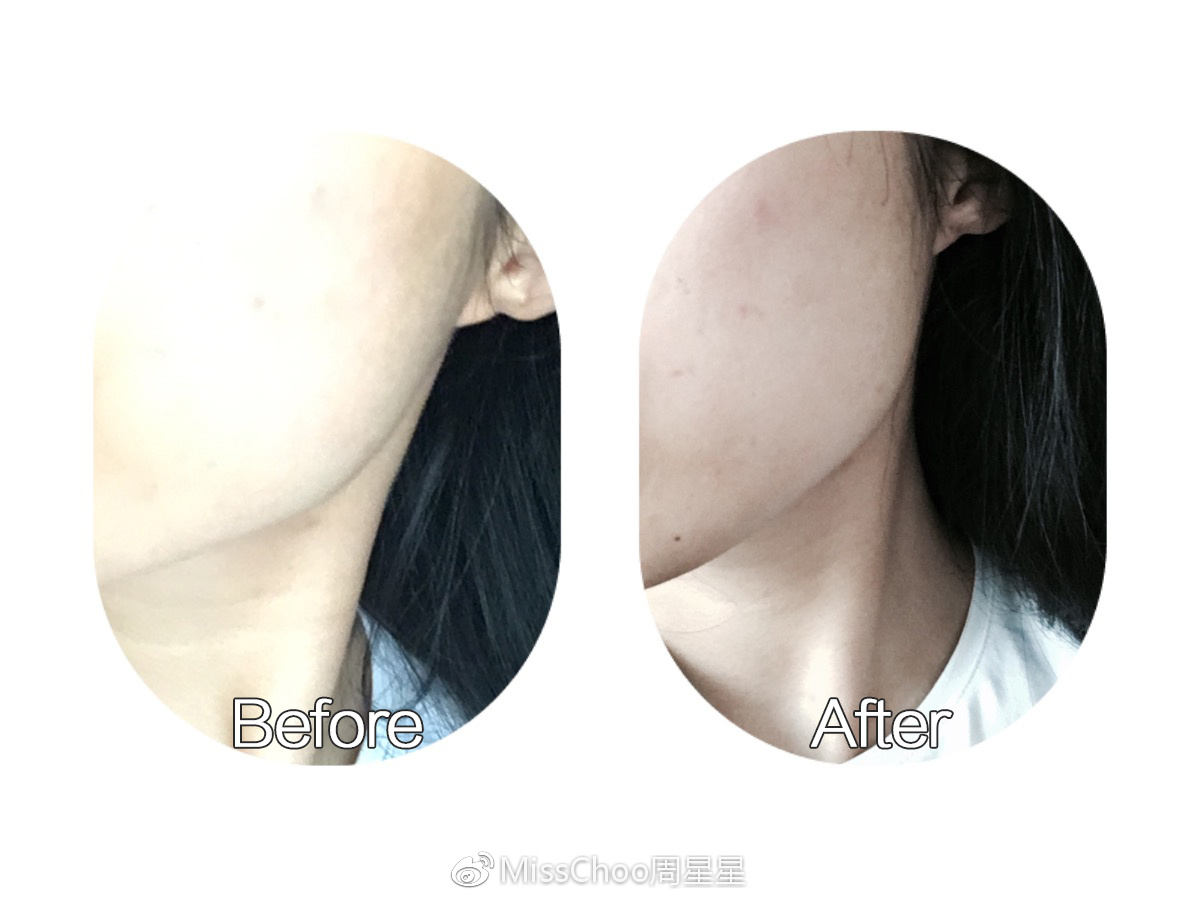 这个高科技，真的能还你十年胶原蛋白？