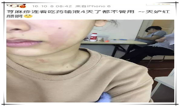 最有效抗过敏茶,可以舒缓皮肤过敏的茶