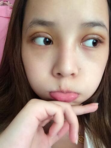 韩式三点定位恢复图片,韩式三点双眼皮恢复一个月图片