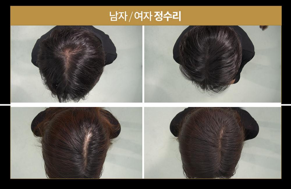 为什么没人敢去植发,为什么很多人都没有去植发