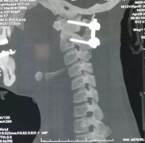 寰枢椎脱位手术适应症,寰枢椎脱位手术最广泛麻醉方法