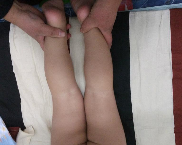 幼儿x型腿怎么办,婴幼儿x型腿走路是什么样子
