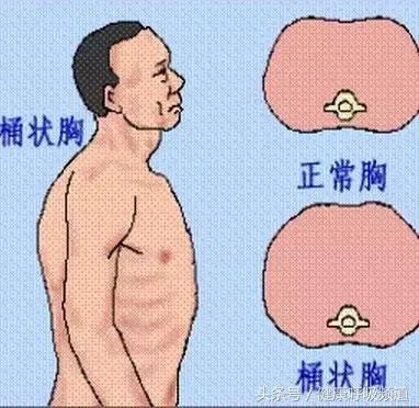 慢阻肺肺气肿的最佳治疗方法,肺气肿买什么样的呼吸锻炼仪好