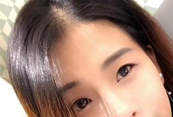 割双眼皮一个月效果,40岁割双眼皮效果好不