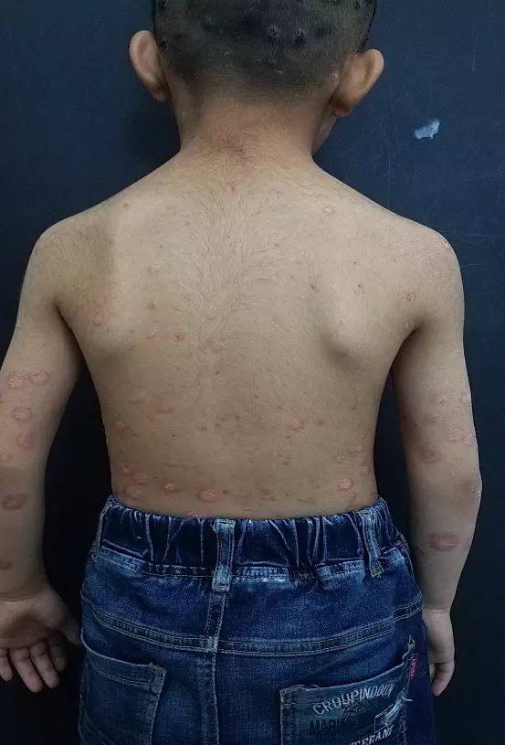 银屑病的日常护理与注意事项,银屑病患者饮食注意事项有哪些