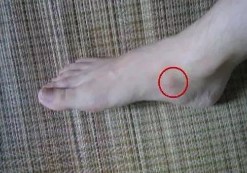 打完球脚踝和足弓疼,打完球足弓疼痛是不是扁平足