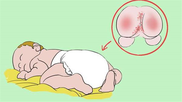 宝宝反复红屁股应该怎样应对呢,宝宝红屁股怎么办教你一招