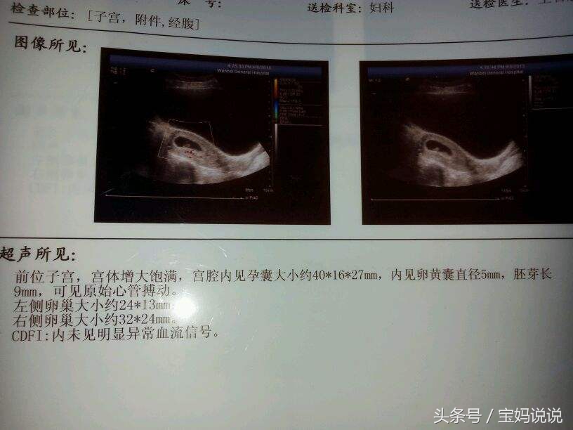 孕期“绝不能少”四次彩超检查你知道吗？让超声科大夫告诉你……