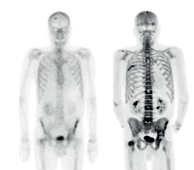 什么是ect肺通气显像,什么是ect