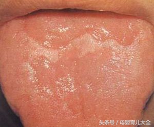 宝宝地图舌是缺维生素吗,11个月宝宝有地图舌