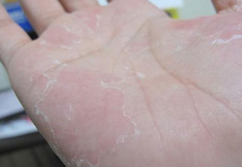 十岁小孩手脚脱皮是什么原因,手脚遇水脱皮是什么原因