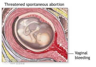 医学科普孕早期宫腔积血,医学博士科普怀孕