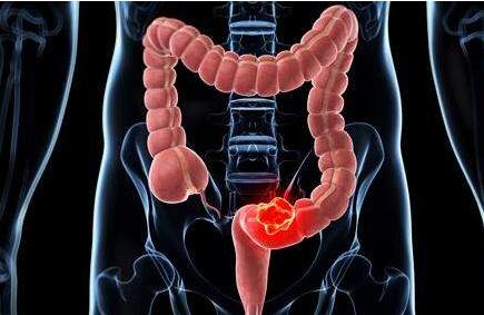 结肠癌发展到晚期时的六大症状，排便习惯是一个影响因素