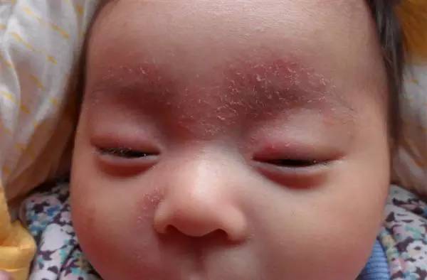 新生儿湿疹热疹区别,新生儿脸上起热疹和湿疹用什么药