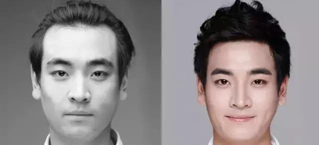 越来越多的男性整形,男士整容变帅案例