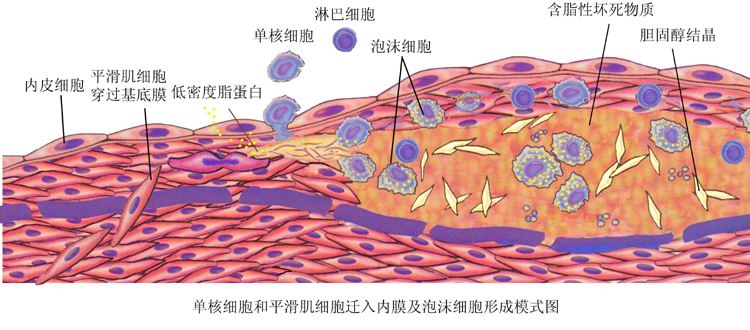 左侧股总动脉粥样斑块形成,吸烟造成动脉粥样斑块形成