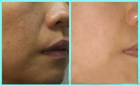 油性皮肤粗糙毛孔大怎么改善,男人皮肤粗糙毛孔大怎么改善