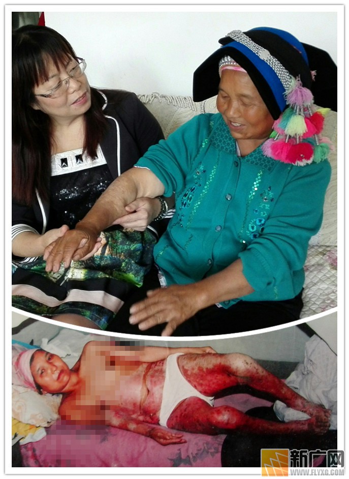 彝族村民李增贵烤贾酒盼脱贫遇火灾，栽多少包谷才能抚平49%烧伤