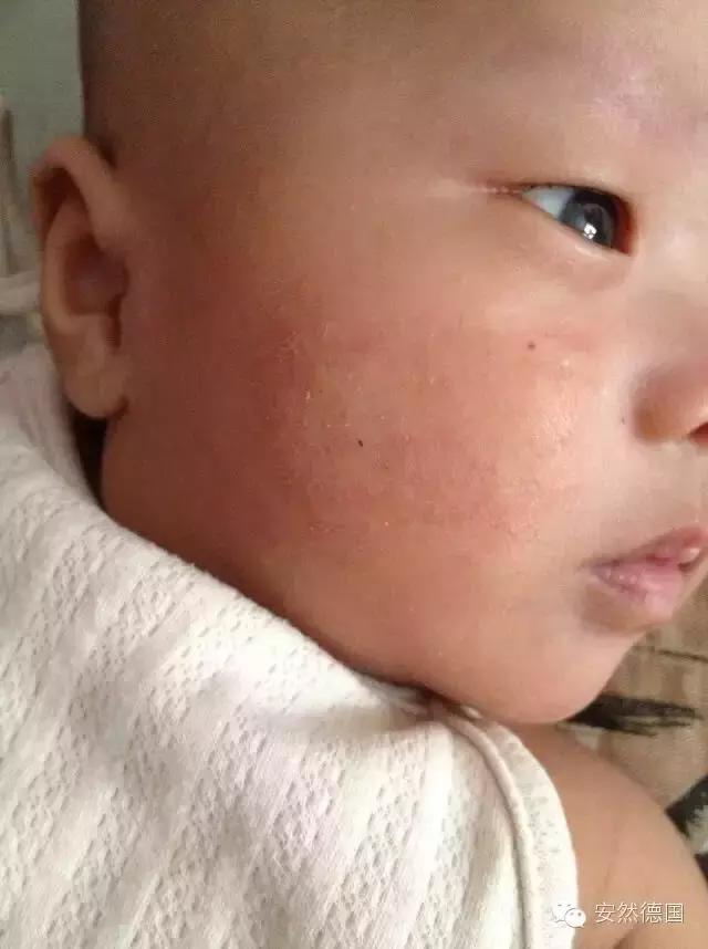 和宝宝湿疹大战,中医看婴幼儿过敏湿疹