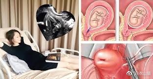 23周宝宝，脚已经掉出来，还能塞回去安胎吗？