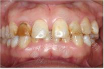 牙龈不增生的降压药,降压药引起的牙龈增生会好吗