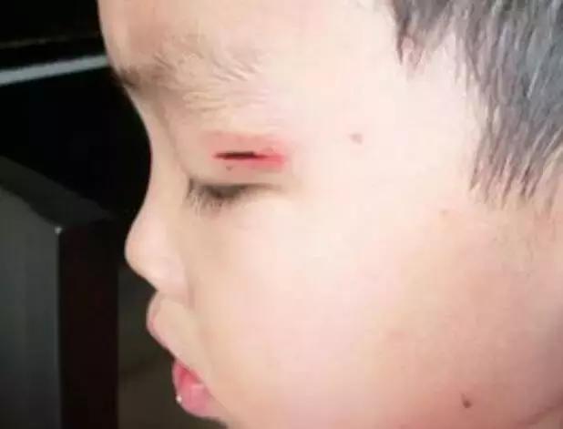 伤口摔伤了破皮怎么处理,宝宝摔伤疤怎么处理