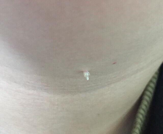 手上的瘊子如何根治,手上的瘊子怎么才能彻底治好