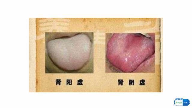 看舌头判断是肾阴虚还是肾阳虚,怎么自己判断是肾阴虚还是肾阳虚