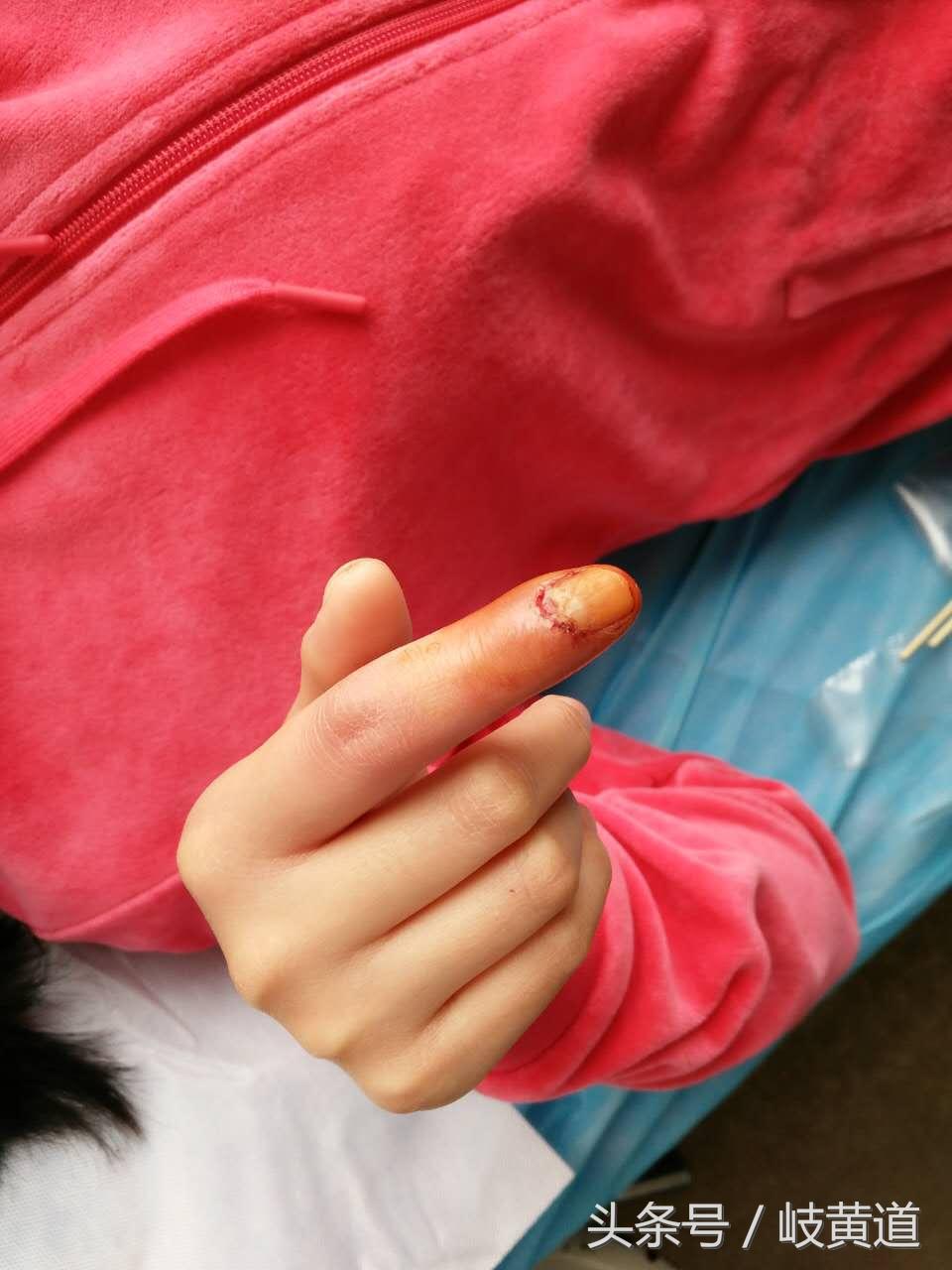 女子手撕倒刺后续,女子手撕倒刺进了医院