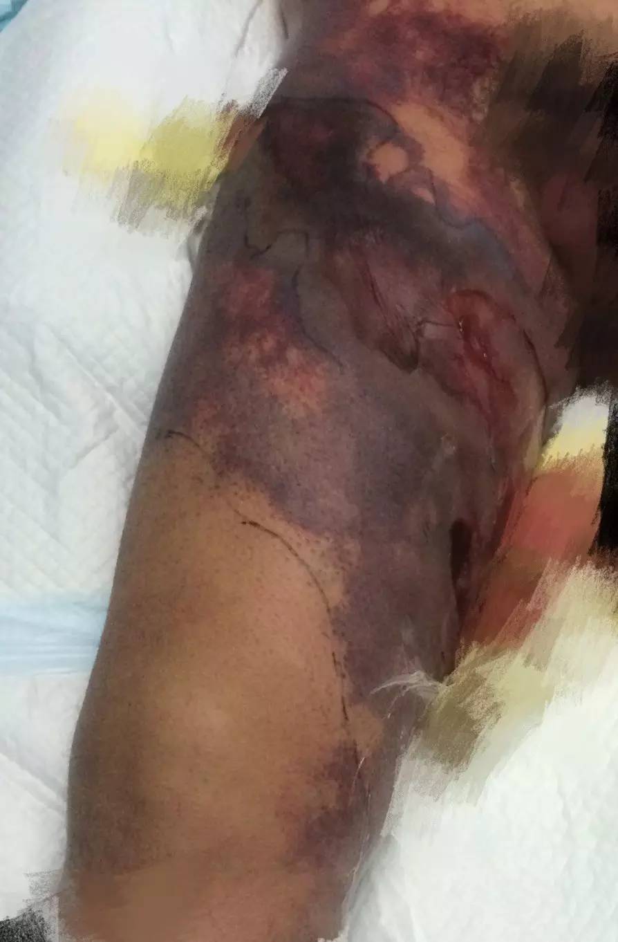 感冒脓毒血症,小孩感冒引起的脓毒血症