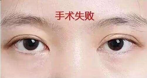 全切双眼皮增生不对称变丑,割完双眼皮为啥会变内双