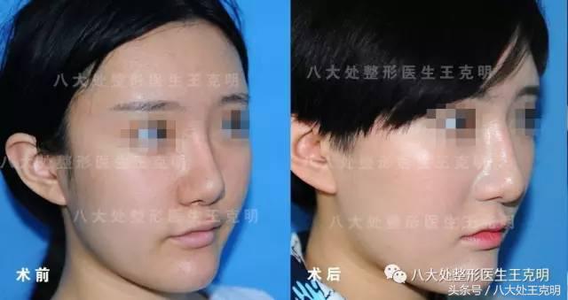 鼻整形后出现肿胀、假体外露歪斜、皮肤异样该怎么办?