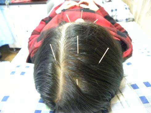 治疗各种头痛的口诀,治头痛的10首验方