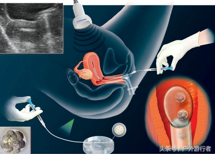 试管婴儿的亲身经历过程,宝妈自述三代试管成功经历