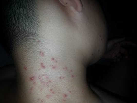 消了又长的疮是什么疮,脸部长疮的症状和治疗方法