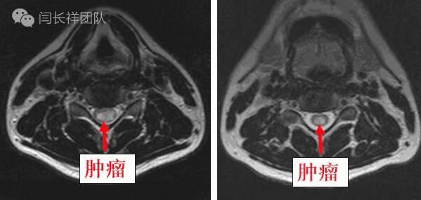 闫长祥脑膜瘤,闫长祥能治愈弥漫中线胶质瘤吗