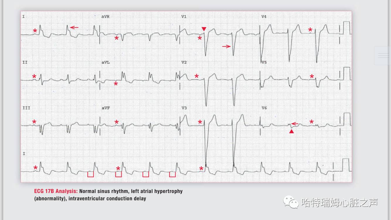 读心有术171,读心有术心电图