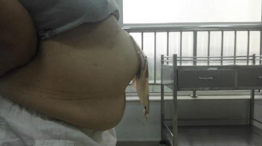 什么是人造肛门?为什么有的能还纳有的要带终身