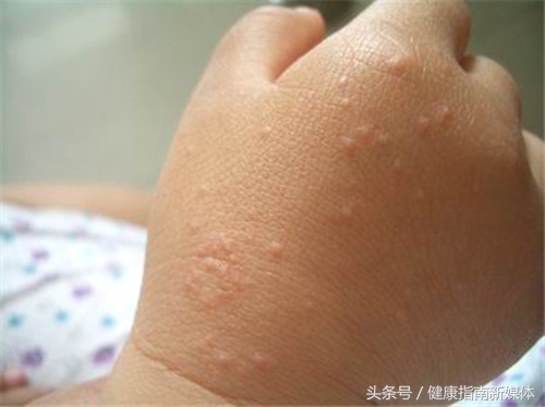 宝宝手上沙土皮炎怎么办,孩子手背沙土皮炎图片