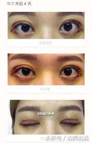 外科医生申霄,申霄医生双眼皮风格