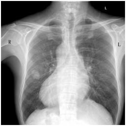 北京协和医院肺癌手术是开胸吗,北京协和纵隔镜手术