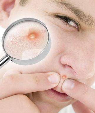 祛痘心酸史真实案例,那些年祛痘走过的弯路