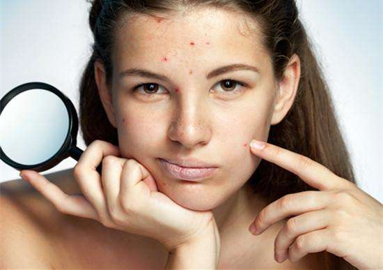 祛痘祛痘印最有效的方法小妙招,如何正确祛痘祛痘印小妙招