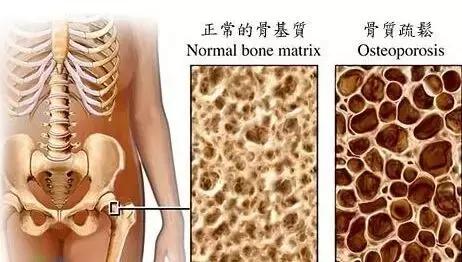 更年期骨质疏松要怎么办,更年期如何补钙防骨质疏松