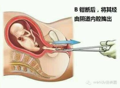 切勿轻视人工流产对女性的伤害,人工流产对女性造成的伤害有哪些