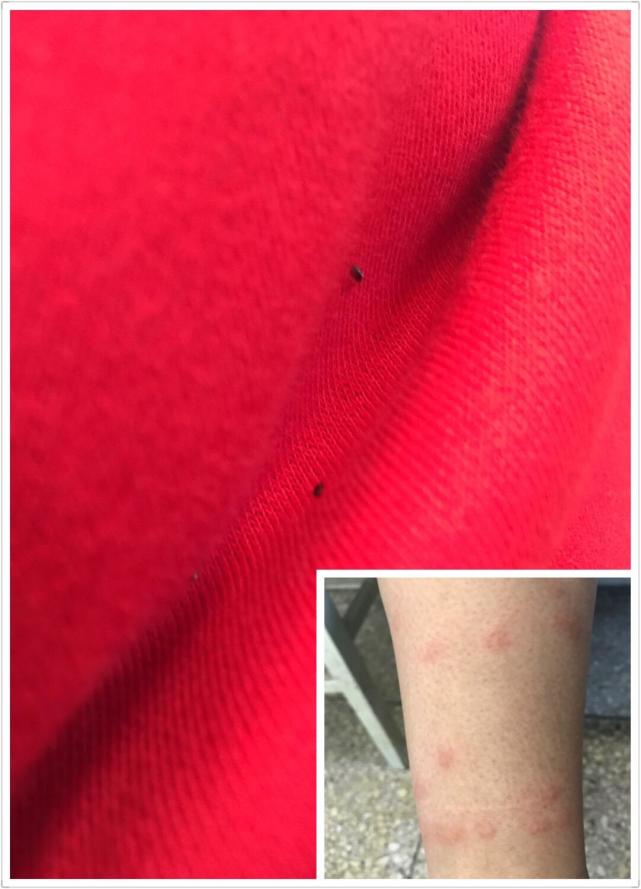 关于跳蚤叮咬人的三个小故事，也许你也经历过！