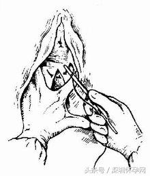 生娃其实没那么痛,顺产侧切的整个过程